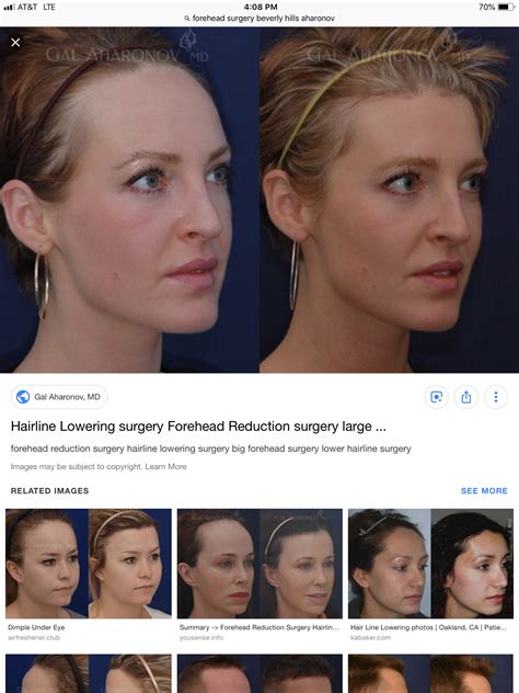 Forehead Reduction Surgery Beauty Tips Beauty Hacks Botox Fillers
