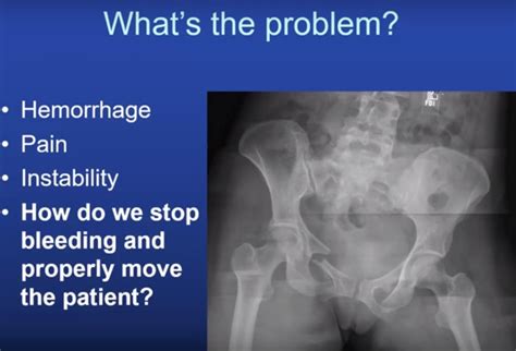 Pelvic Fracture Basics Orthopaedicprinciples