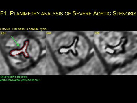Aortic Stenosis Cardiac Mri