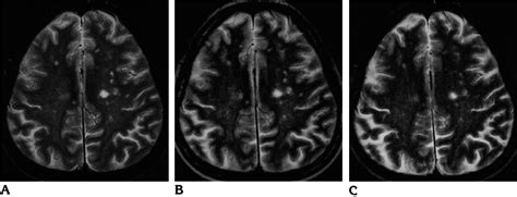 A 55 Year Old Patient With Presumed Microvascular Ischemic Moyamoya