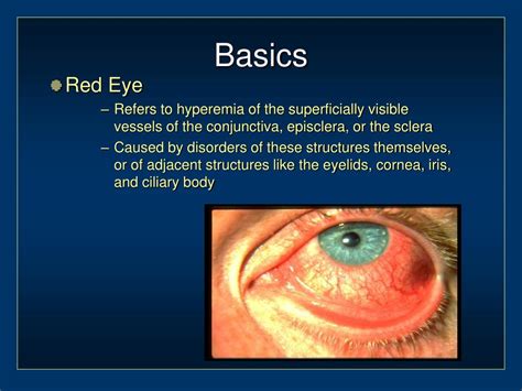 Ppt Red Eye Powerpoint Presentation Free Download Id6983014