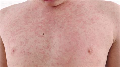 Cdc Reported Measles Cases Up 100 From Previous Week