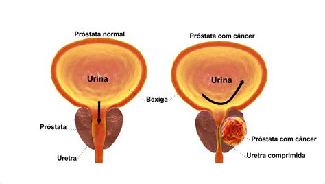 Câncer de Próstata Definições e Sintomas Clínica Afetus