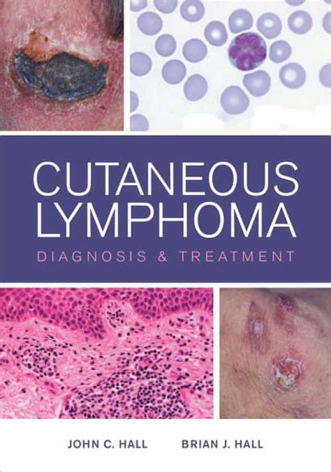 Cutaneous Lymphoma Diagnosis And Treatment Coop Zone