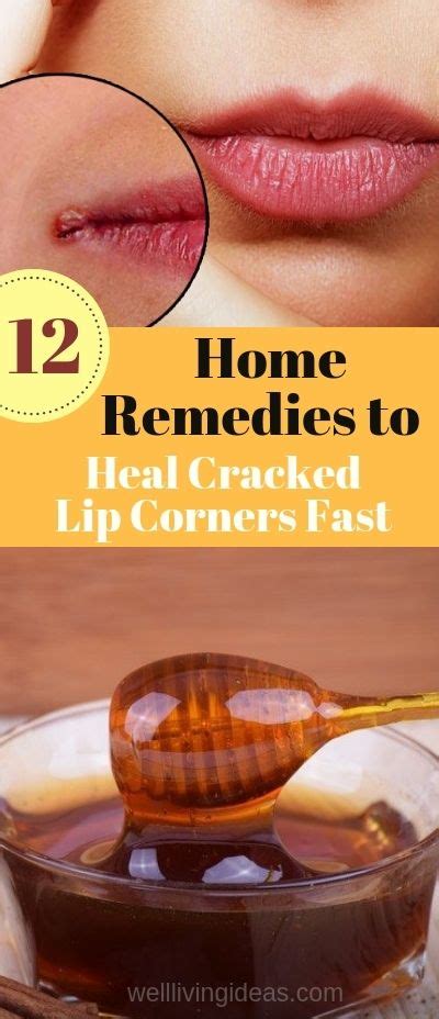 Best Angular Cheilitis At Home Remedy Trend In 2022 Interior And