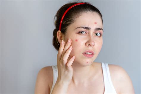 Acne Causes Symptoms And Prevention Ssb Hospital