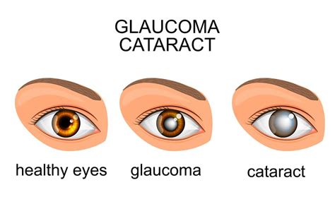 Can I Have Cataract Surgery If I Have Glaucoma Ic 8 Lens