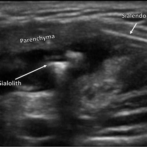 Ultrasonogram Of The Left Submandibular Gland Small Salivary Stone