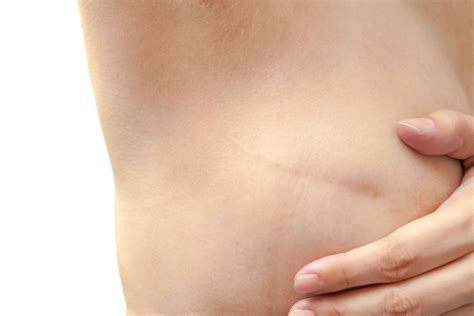 Scarring And Breast Cancer Treatments