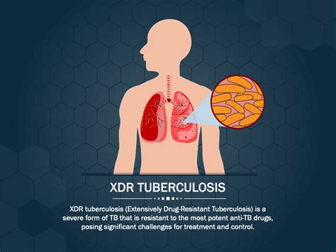 XDR Tuberculosis PowerPoint Template And Google Slides Theme