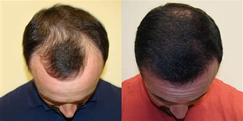 How To Reverse Balding In One Maxharvest Procedure Dr Brett Bolton