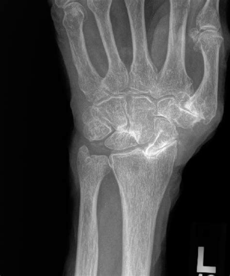 SLAC Wrist Arthritis - Raleigh Hand Center | Raleigh Hand ...