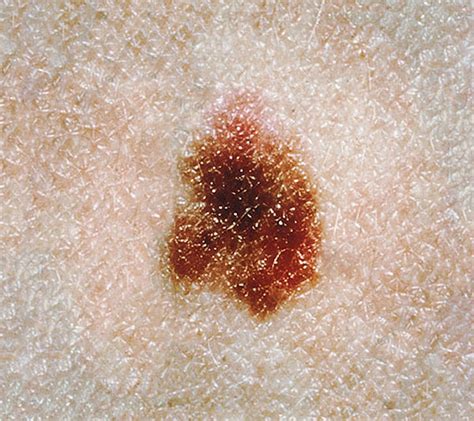 Atypical Mole On Scalp Skin Cancer On Scalp Skin Check Waskin Check