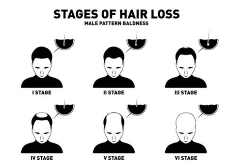 Male Pattern Baldness Hair Loss In Men Harley Street Htc