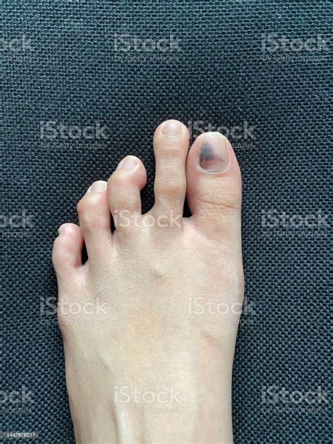 Foot With A Subungual Hematoma Disease Stock Photo Download Image Now