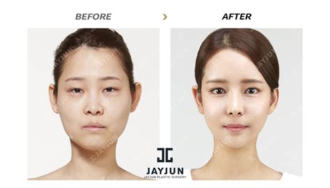 Nose Surgery In Korea Rhinoplasty Revision In South Korea Korea Nose Surgery Korea Nose Revision