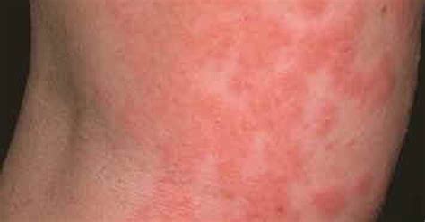 How To Treat Rashes From The Side Effects Of Lactobacillus Ehow Uk