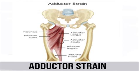 Adductor Strain World Wide Lifestyles Weight Loss And Gain Tips