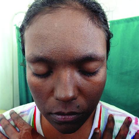 Bilateral Erythema Follicular Papules And Hyperpigmentation On The