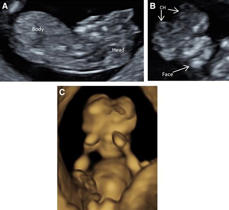 Exencephaly Anencephaly Sequence American Journal Of Obstetrics And Gynecology