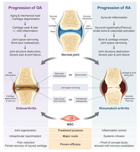 Progression Of Rheumatoid Arthritis Ra And Osteoarthritis Oa In