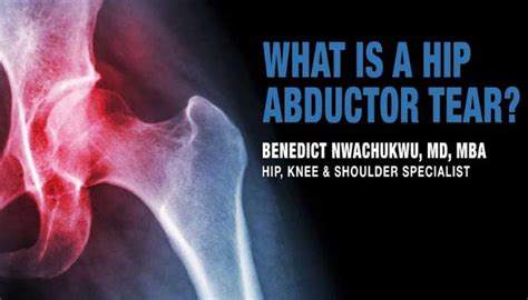 Hip Education Archives Benedict Nwachukwu Md Mba Hip Knee
