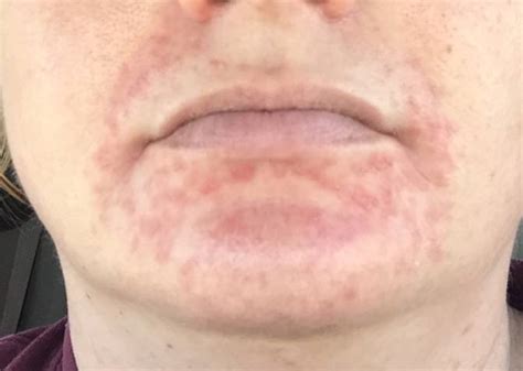 Perioral Dermatitis Treatment Causes And Symptoms Hickey Solution