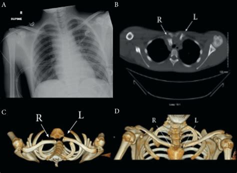 Cureus Emergent Management Of Traumatic Posterior Sternoclavicular Joint Dislocation A Case
