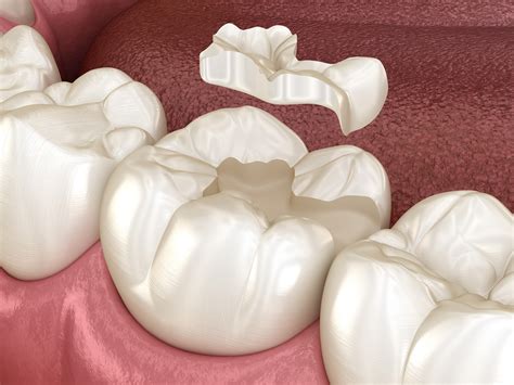 Inlaysonlays Detail Dental