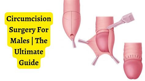 Circumcision Surgery For Males The Ultimate Guide