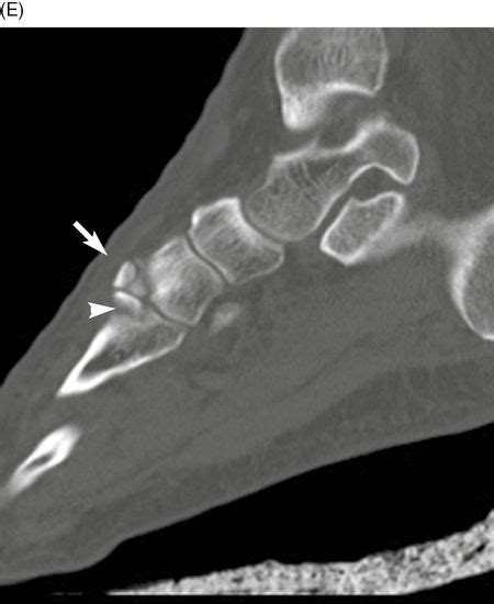 Fractures and dislocations of the metatarsals and toes ...