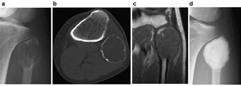 Osteoscopic Surgery Of Giant Cell Tumor Of Bone For Preservation Of