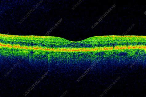 Normal Retina Oct Scan Stock Image C0267621 Science Photo Library