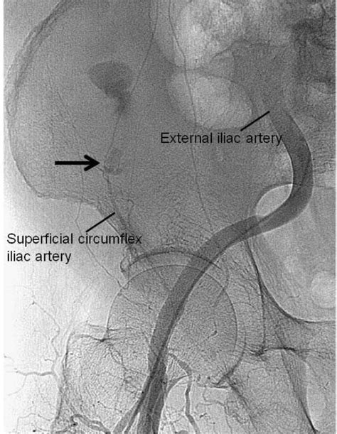 External Iliac Femoral Artery