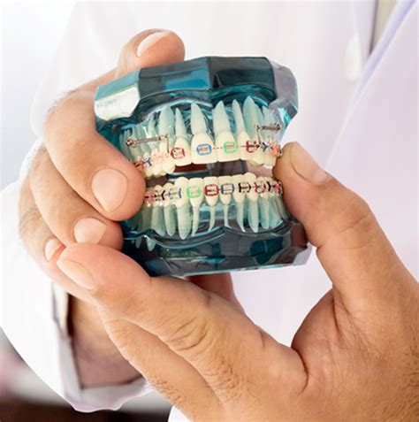 Best Braces Dentist In Dubai Best Price Teeth Braces In Dubai 65 Off
