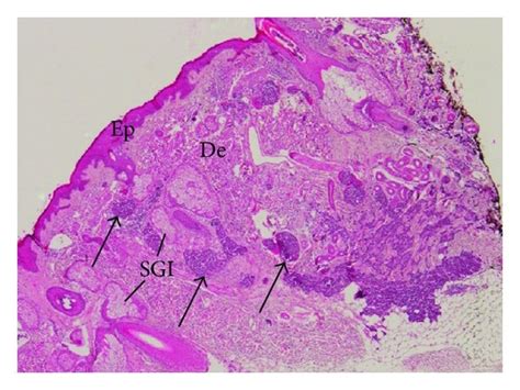 Representative Example Of Histology Of Merkel Cell Carcinoma From A