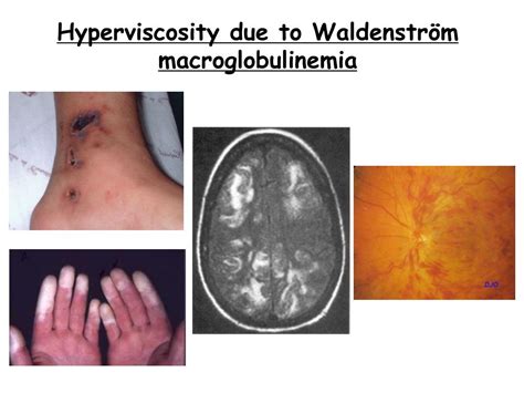 Ppt Waldenström Macroglobulinemia Powerpoint Presentation Free