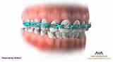 Orthodontic Chains Images