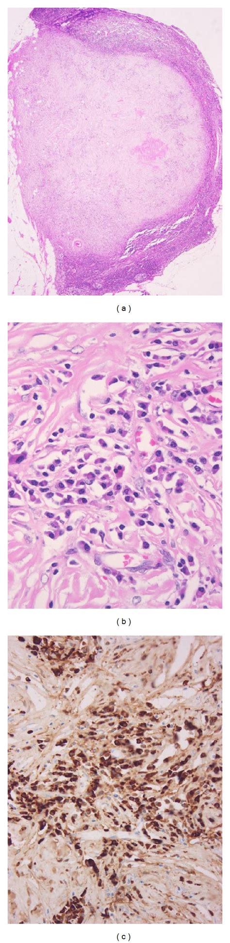 Igg4 Related Lymphadenopathy Type V This Is A Regional Lymph Node