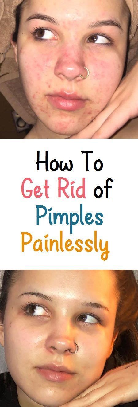 How To Get Rid Of Pimples Painlessly How To Get Rid Of Pimples