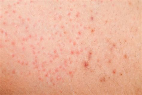 Causes And Treatment Of Itchy Underarm Dr Nina Skin