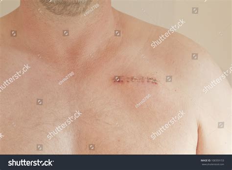 Pacemaker Scar On Male Aged 45 Stock Photo 108359153 Shutterstock