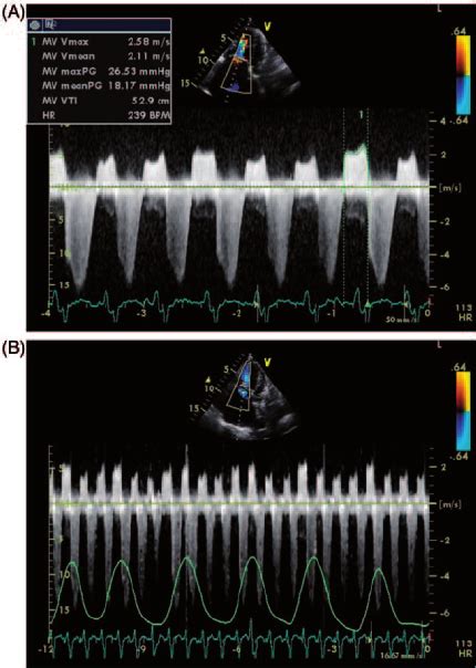 A The Tricuspid Valve Peak Inflow Gradient Of 27 Mm Hg And Mean