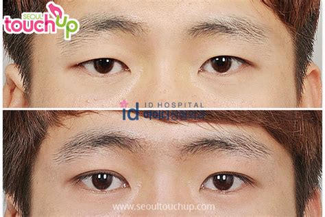 Double Eyelid Surgery Before And After Seoul Touchup