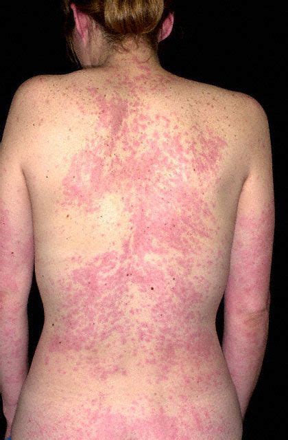 Pin By Matthew Tweed On Hives Urticaria Skin Allergies Hives Rash