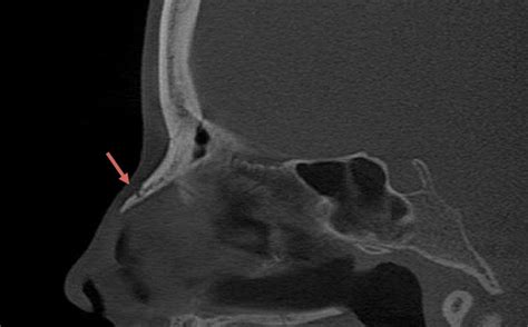What Is The Best Imaging Study To Evaluate A Broken Nose