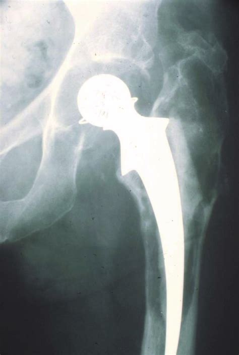X Ray Example Of Patient With A Loosened Cemented Total Hip Prosthesis