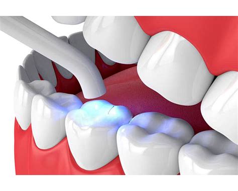 ¿qué Son Las Resinas Dentales ¿cuáles Son Sus Ventajas Odontovida