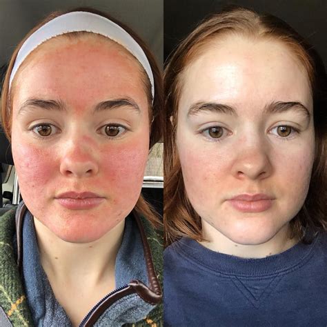 Kali Acne Positivity On Instagram Day Of My Prp Microneedling