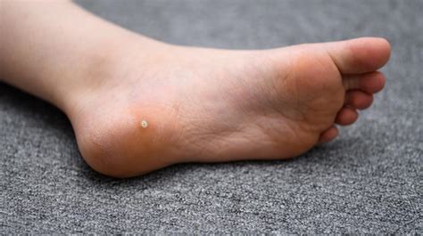 6 Things To Know About Plantar Warts